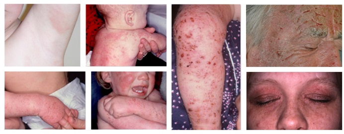Quels moyens aident au psoriasis